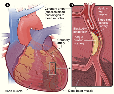 coronary-heart-disease